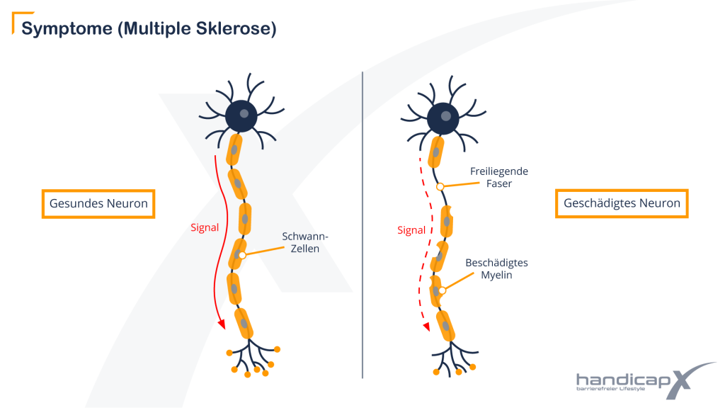 Gegenüberstellung eines gesunden und eines geschädigten Neurons bei Multipler Sklerose (MS)